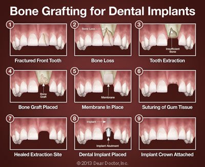 bone grafting