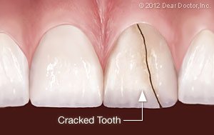 Cracked teeth 2