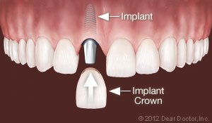 Dental Implants 2