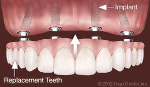 Dental Implants 3