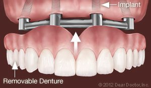 Dental Implants 4