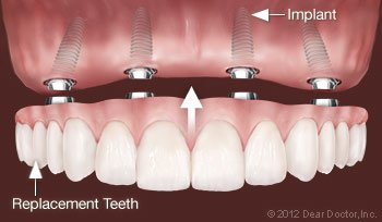 fixed dentures 2