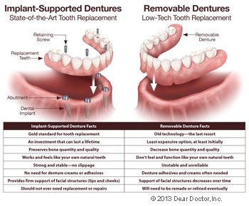 fixed dentures