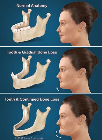 Teeth loss