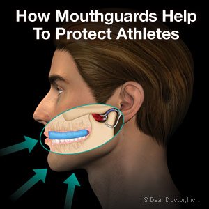 mouthguards for children 2