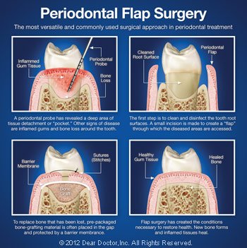 Periodontal flap