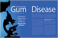Gum disease 3