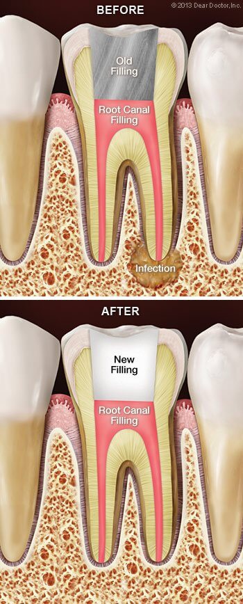 Root canal pretreatment