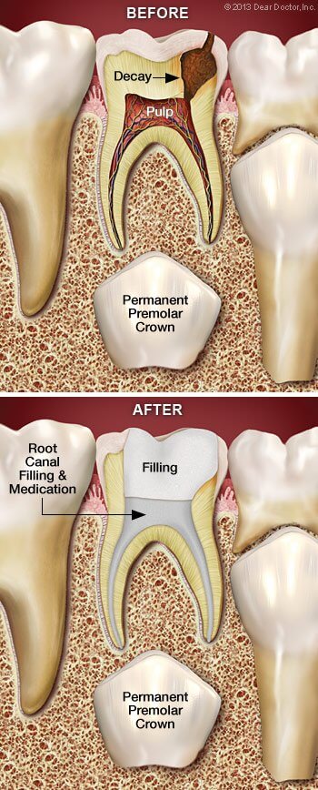 root canal for kids 2