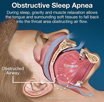 Sleep Apnea 2