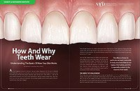 Tooth wear 3