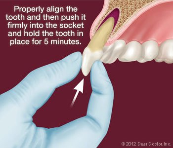dental injuries 3