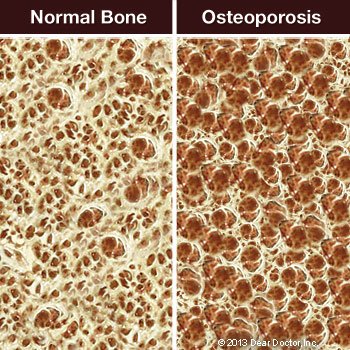 Normal bone vs osteoporosis.