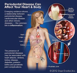 Periodontal Disease Can Affect Your Heart and Body.