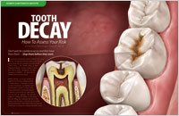 Tooth Decay - Dear Doctor Magazine