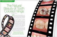Tooth-Colored Fillings - Dear Doctor Magazine