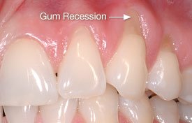 Gum Recession - Abrasion.